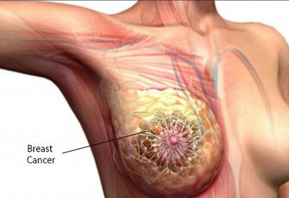 Breast Cancer Information In Marathi