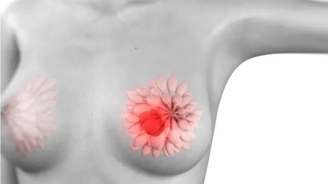 Breast Cancer Information In Marathi